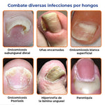 ELIMINA LOS HONGOS DE LAS UÑAS EN 5 DÍAS Y EVITA QUE APEREZCAN PARA SIEMPRE